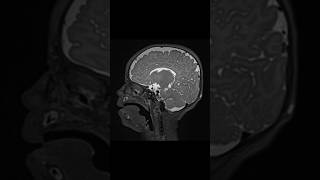 Knobloch syndrome mribrain shoets [upl. by Nannerb]