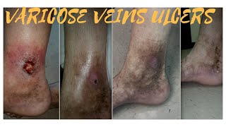 Best Treatments for Varicose veins symptoms causes life style treatment options prevention [upl. by Meggs]