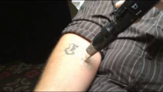 PicoSure Laser Tattoo Removal Demonstration in Toronto  SpaMedicaTV [upl. by Elrem]