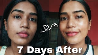 How I Repair My Uneven Skin in 7 Days at home With Affordable skincare and Homemade DIY Routine [upl. by Gnex443]