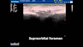 Ultrasound guided supraorbital nerve block Face block [upl. by Daugherty]