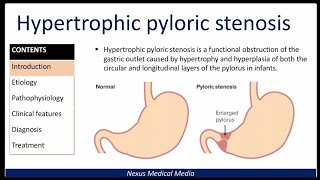 Hypertrophic Pyloric stenosis [upl. by Riaj]