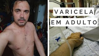 VARICELA EM ADULTO  A minha experiência [upl. by Demodena237]