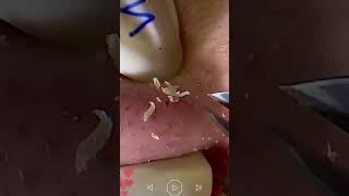 Skincare  Blackheads Removal 255 tweezers skincare blackheads blackheads [upl. by Nallad]