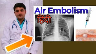 air Embolism in hindi injection bubble [upl. by Borszcz]