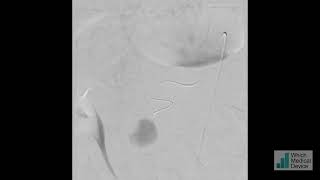 Embolisation of IPDA pseudoaneurysm with Glubran [upl. by Lenore]