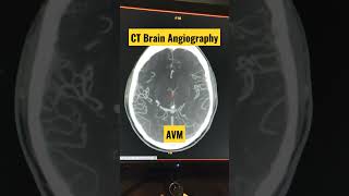 CT Brain Angiography Diagnosing AVM shorts trending viral radiology [upl. by Ardried952]