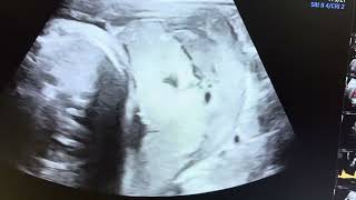 Ultrasound of Placental abruption [upl. by Shoemaker]