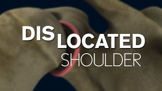 What happens during a shoulder dislocation [upl. by Reinhold]