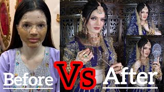 VITILIGO GIRL MAKEUP TRANSFORMhow to do bridal makeup new tricks and techniques for beginners 2024 [upl. by Korman]