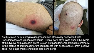 Ecthyma gangrenosum bei Pseudomonas aeruginosa Sepsis [upl. by Maurice228]