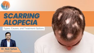 What is scarring alopecia  Types Causes Diagnosis and treatment options  Dr Alok Sahoo [upl. by Adrian]