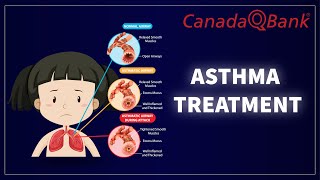 Asthma Treatment [upl. by Fulbert]