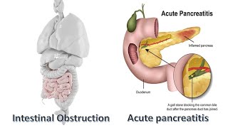 Intestinal Obstruction ampacute pancreatitis in emergency تتصرف ازاى وانت فى الاستقبال [upl. by Akerdnahs]