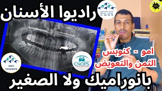 راديو بانوراميك PANORAMIQUE راديو صغير تغليف الاسنان قتيل العرق فيكس كنوبس سنيسيس امو CNOPS AMO CNSS [upl. by Debbee518]