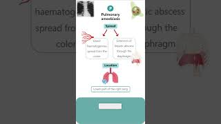 PULMONARY AMOEBIASIS parasitology microbiology pathology neet neetpg amoebiasis amoeba [upl. by Ahsiryt]