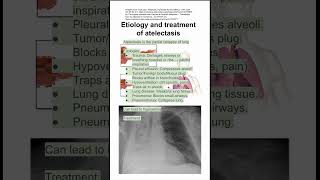 Etiology and treatment of atelectasis [upl. by Kessiah]