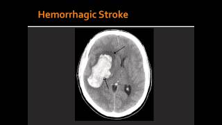 Atherosclerosis Hemorrhagic Stroke Ischemic Stroke amp Transient Ischemic Attack TIA [upl. by Rothberg]