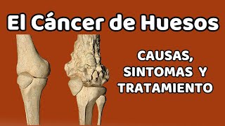 CÁNCER DE HUESOS Causas signos y síntomas diagnóstico y tratamiento [upl. by Range]