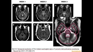 45 Osmotic demyelination syndrome ODS pontine myelinolysis hyponatriemia correction piglet sign [upl. by Nortal237]