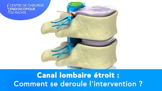 CANAL LOMBAIRE ÉTROIT  Comment se déroule lintervention [upl. by Elleyoj]