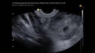 Misdiagnosed ectopic pregnancy mimicking adnexal malignancy a report of two cases [upl. by Dong]