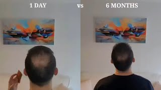 How to Derma Roll for Hair Regrow  My Half a Year Results [upl. by Dylan]