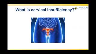 Treatment of Cervical Insufficiency [upl. by Killen]