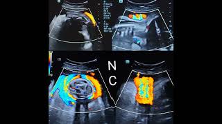 Nuchal Cord Ultrasound [upl. by Brag]