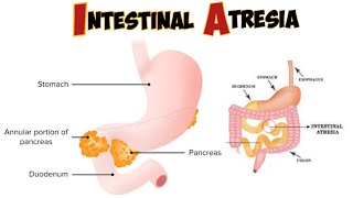 Intestinal atresia amp stenosis [upl. by Coco]