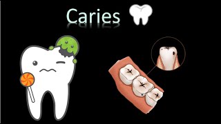 🦷 Caries Dental  Cavidad oral  Cabeza y Cuello  Patología [upl. by Assisi]