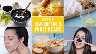 Easy Ways To Remove Blackheads And Whiteheads At Home [upl. by Rraval]