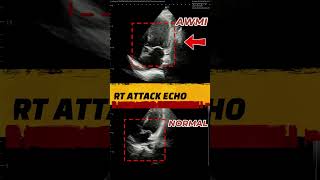 हार्ट अटैक को कैसे पहचाने Heart Attack Echo Animation Shocking 3D Visualizationshorts [upl. by Hirsh]