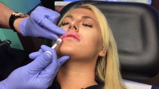 Microdroplet lip injection Using Restylane Juvederm [upl. by Spike566]