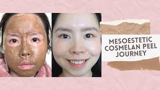 Cosmelan Treatment by Mesoestetic  Removal of Freckles Melasma amp Pigmentation [upl. by Aleka]