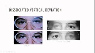 Essential Infantile Esotropia Characteristics [upl. by Maryl]