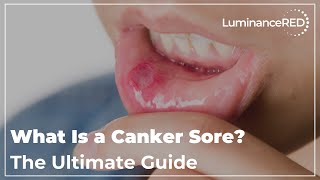 What Is a Canker Sore The Ultimate Guide [upl. by Kenwee]