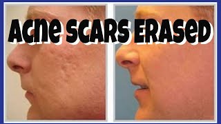 HOW TO COVER ACNE SCARS FLAWLESSLY  Tutorial  CHRIS GIBSON [upl. by Eimia482]