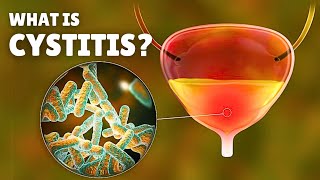 Cystitis – Causes Signs and Symptoms Diagnosis amp Treatment [upl. by Pliam]