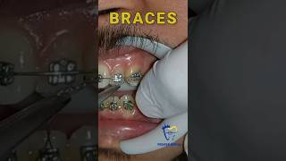 Braces  ligature wire to secure wire on bracket [upl. by Subocaj]