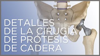 Detalles de la cirugía de prótesis de cadera Dr Ángel Villamor [upl. by Artiek217]