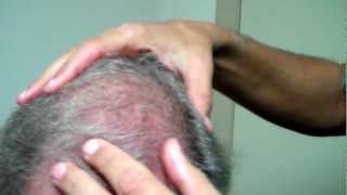 Dr Jeffrey Epstein 11 Months PostOp Chest to Scalp FUE [upl. by Hannaoj]