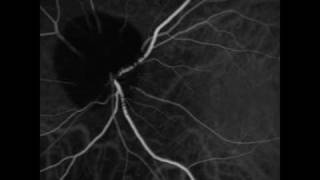 Ophthalmic Melanocytoma of the Optic Nerve [upl. by Haiacim]