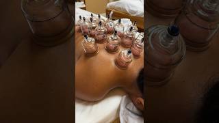 Cupping therapy thailandiamassage [upl. by Oemor732]