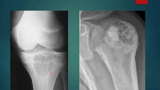 Chondroblastoma case presentation short [upl. by Eiuqnom]