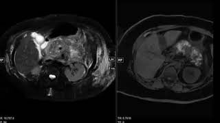 Abdominal Case Conference  772020 [upl. by Eustazio]