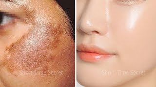 In 2 DAYSRemove DARK SPOTS  Apply Treatment on Your DARK SPOTS and See the Magic [upl. by Stormie548]