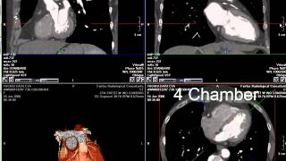 Coronary CT Angiography RCA Stenosis [upl. by Close143]