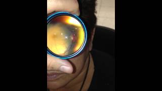 Inexpensive Telemedicine Fundoscopy performed using an Iphone and a 20D lens [upl. by Apollo645]