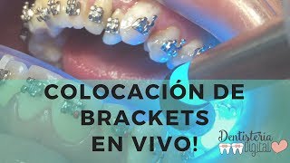 Colocación de Brackets en VIVO  Putting on Braces  LIVE [upl. by Silver81]